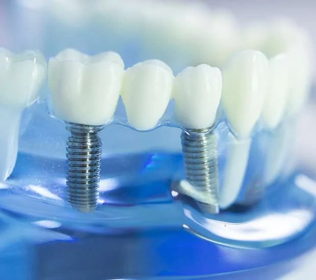 Dental implant treatment illustration